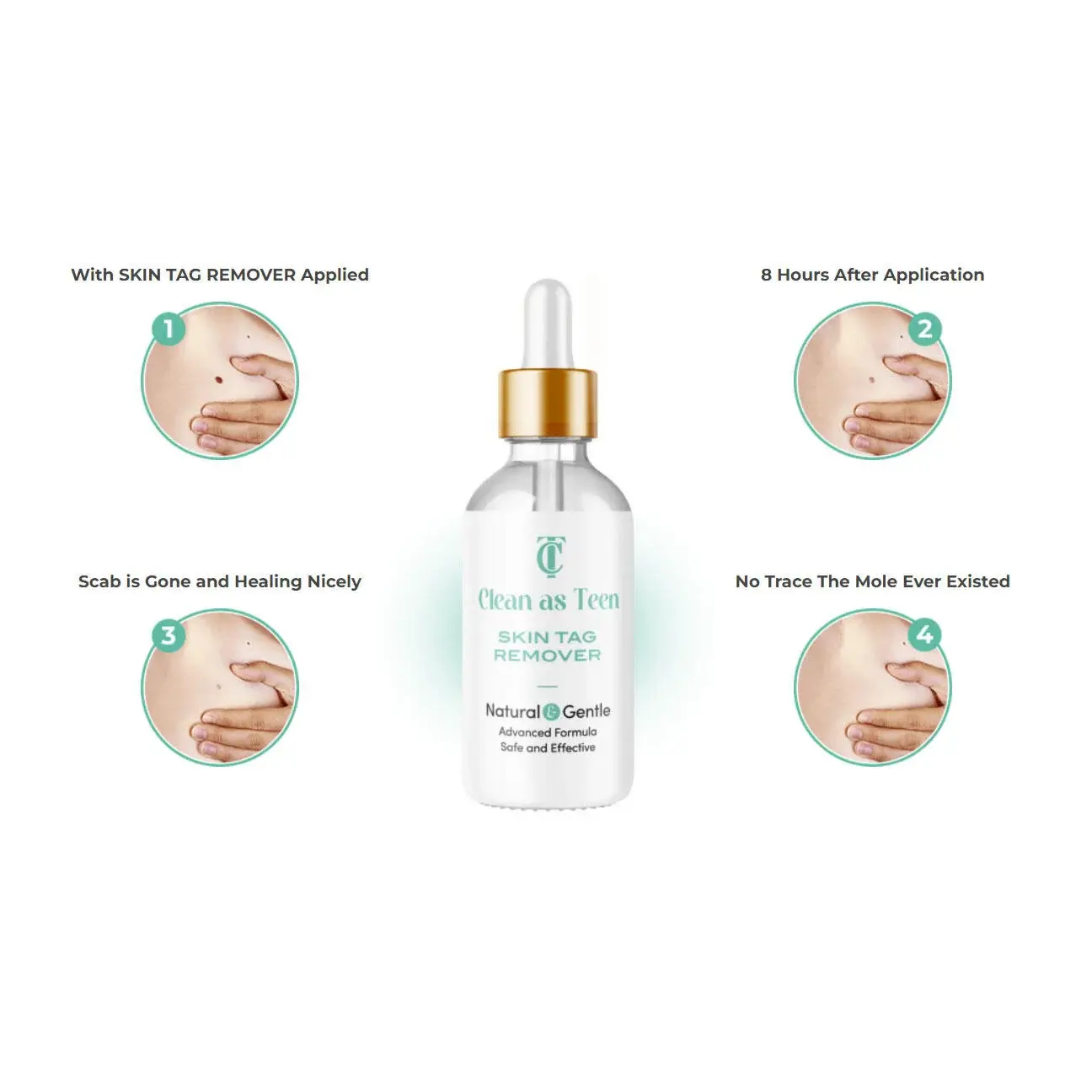 Most Effective and Best Rated Skin Tag Remover